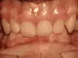 houseoforthodontia-deep-overbite-before