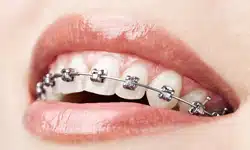 houseoforthodontia-self-ligating-braces