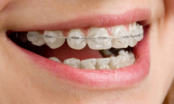 Ceramic Braces in Brooklyn, NY  Invisible Orthodontic Treatment