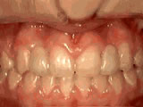 houseoforthodontia-missing-lateral-incisors-after