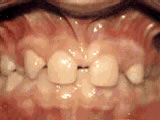 houseoforthodontia-missing-lateral-incisors-before