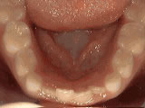houseoforthodontia-non-braces-treatment-before