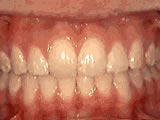 houseoforthodontia-overbite-after