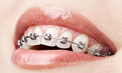 houseoforthodontia-self-ligating-braces