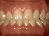 houseoforthodontia-spacing-of-teeth-after