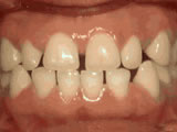 houseoforthodontia-spacing-of-teeth-before