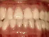 houseoforthodontia-underbite-after