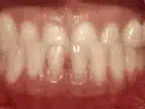 houseoforthodontia-underbite-before