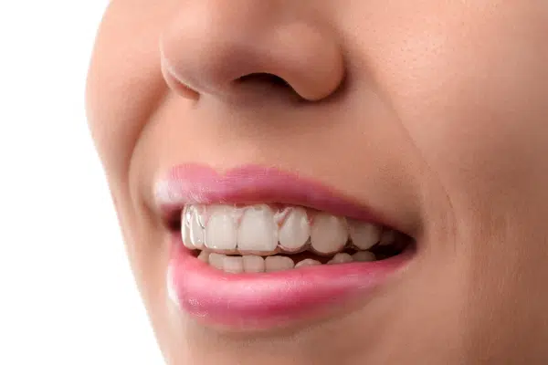 houseoforthodontia-Invisalign-Teen-Cobble-Hill