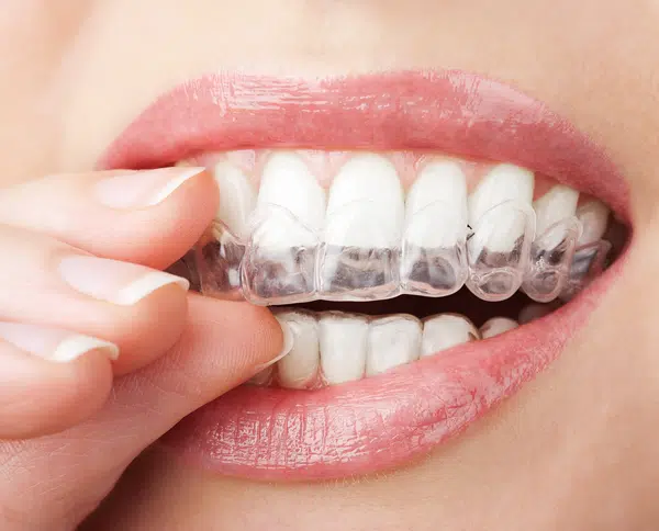 houseoforthodontia-invisalign-cobble-hill