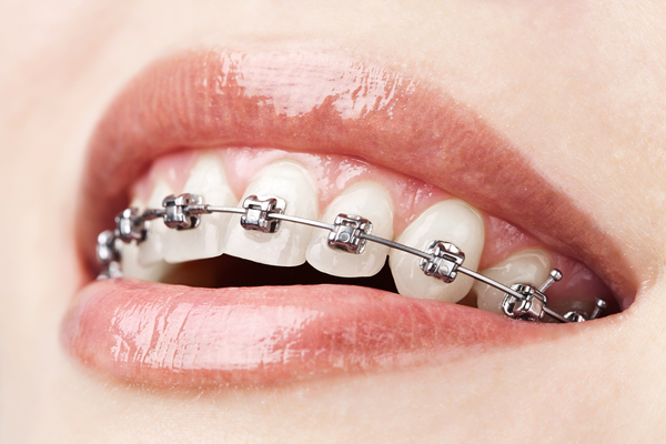 houseoforthodontia-close-up-of-smile-with-braces