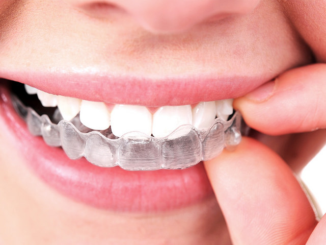 Which is best for you ? Invisalign or Ceramic clear braces - Zen Dental &  Health care