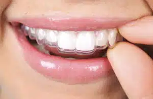 invisalign cost