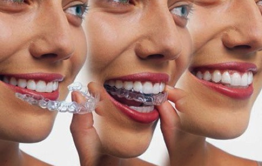 Invisalign Braces NYC Info  Invisalign Dentists In NYC