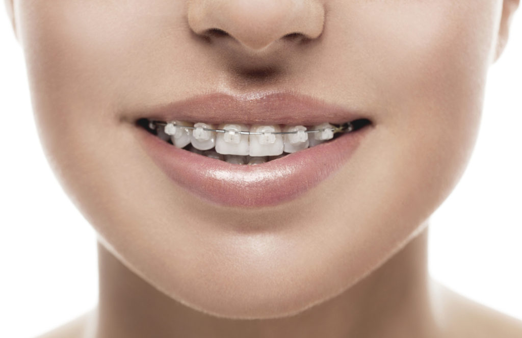 Braces Greenpoint NY House of Orthodontia