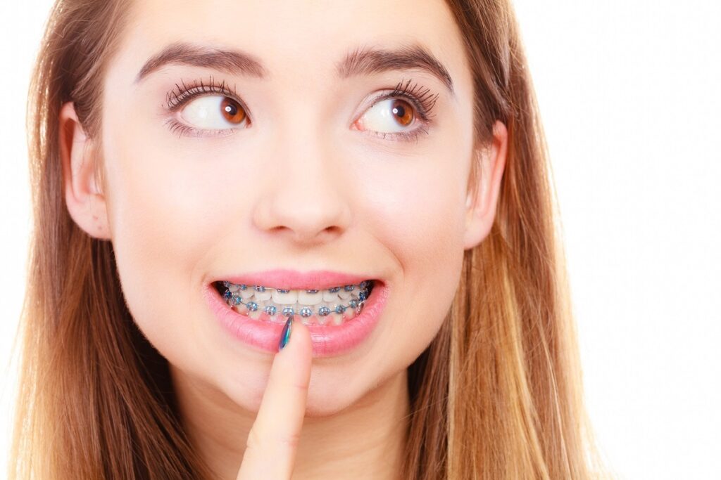 Caring for Braces During a Quarantine House of Orthodontia