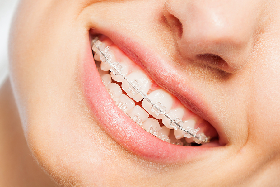 Clear Braces Manhattan