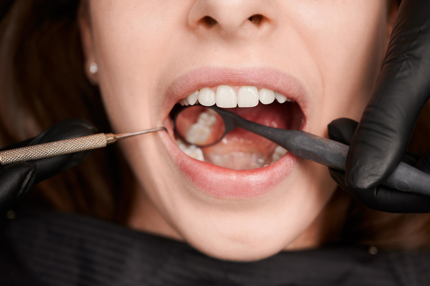 Facts to Know About Lingual Braces in NYC
