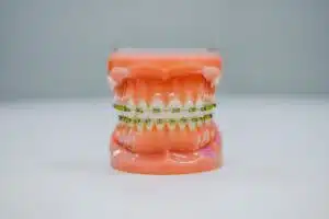 Braces Friendly Foods