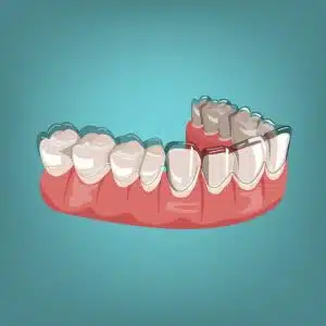 Invisalign vs. braces