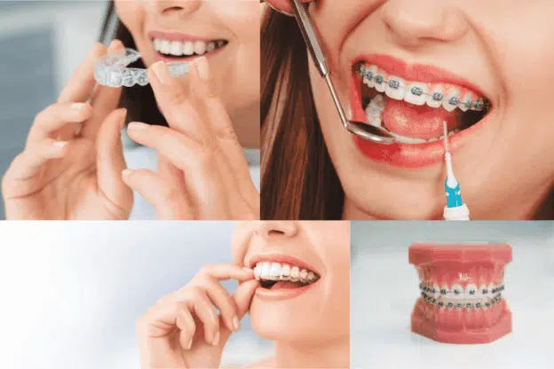 Braces vs Invisalign-Which Option Is Right for You