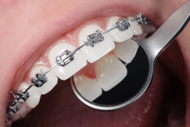 Adult Orthodontics in Brooklyn and Manhattan