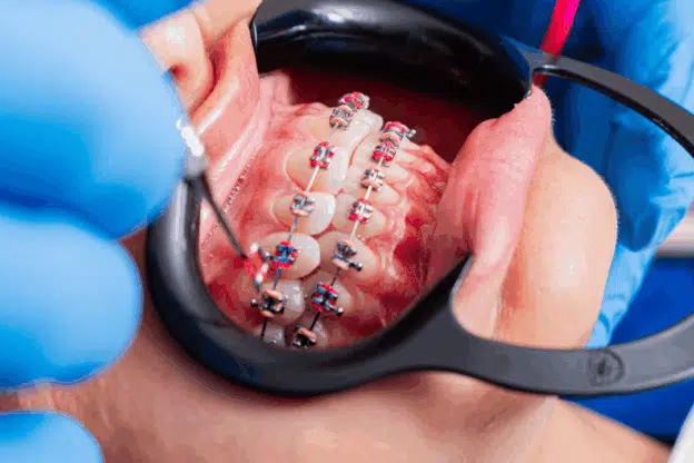 Orthodontic Treatment