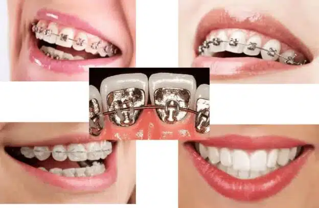 Type of Braces