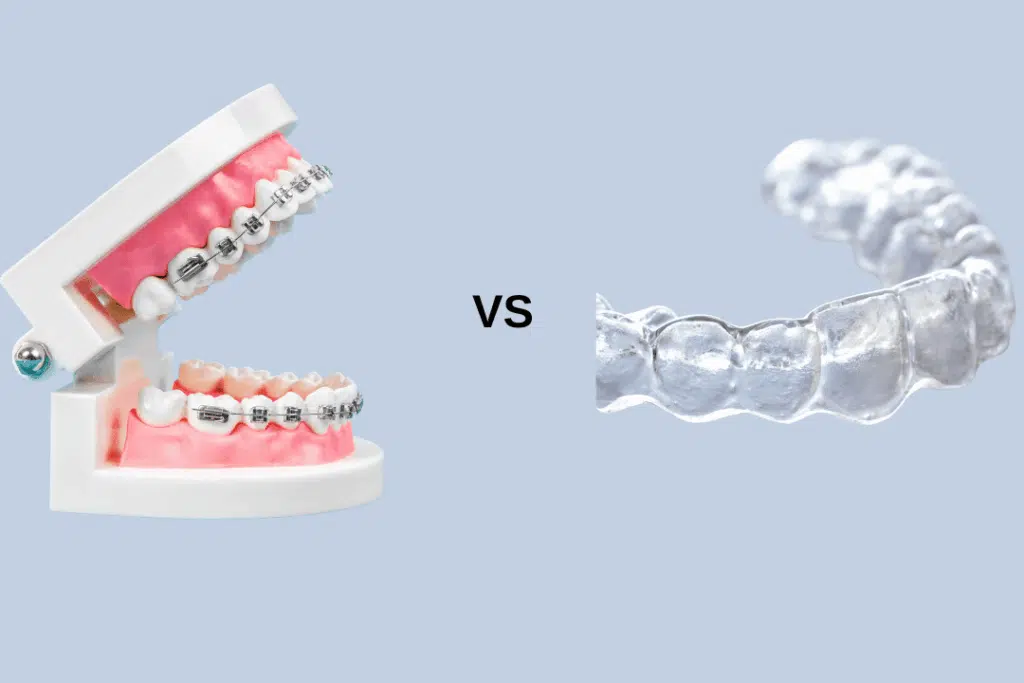 Comparison of traditional braces vs Invisalign
