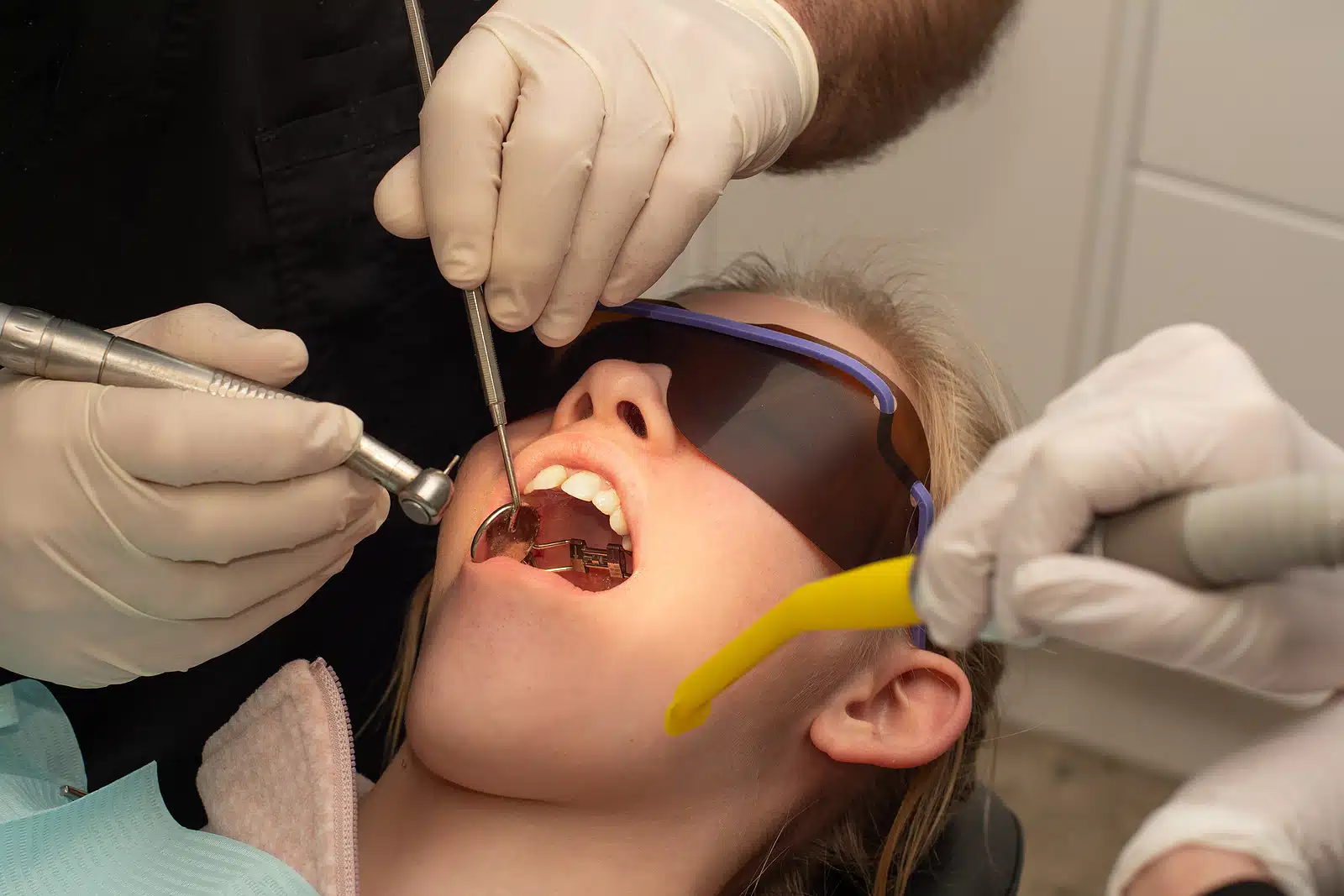 how palatal expander is being placed