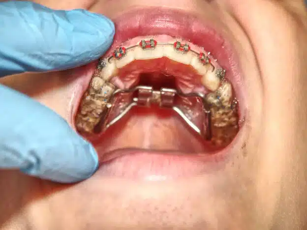 palatal expander in Brooklyn, NY