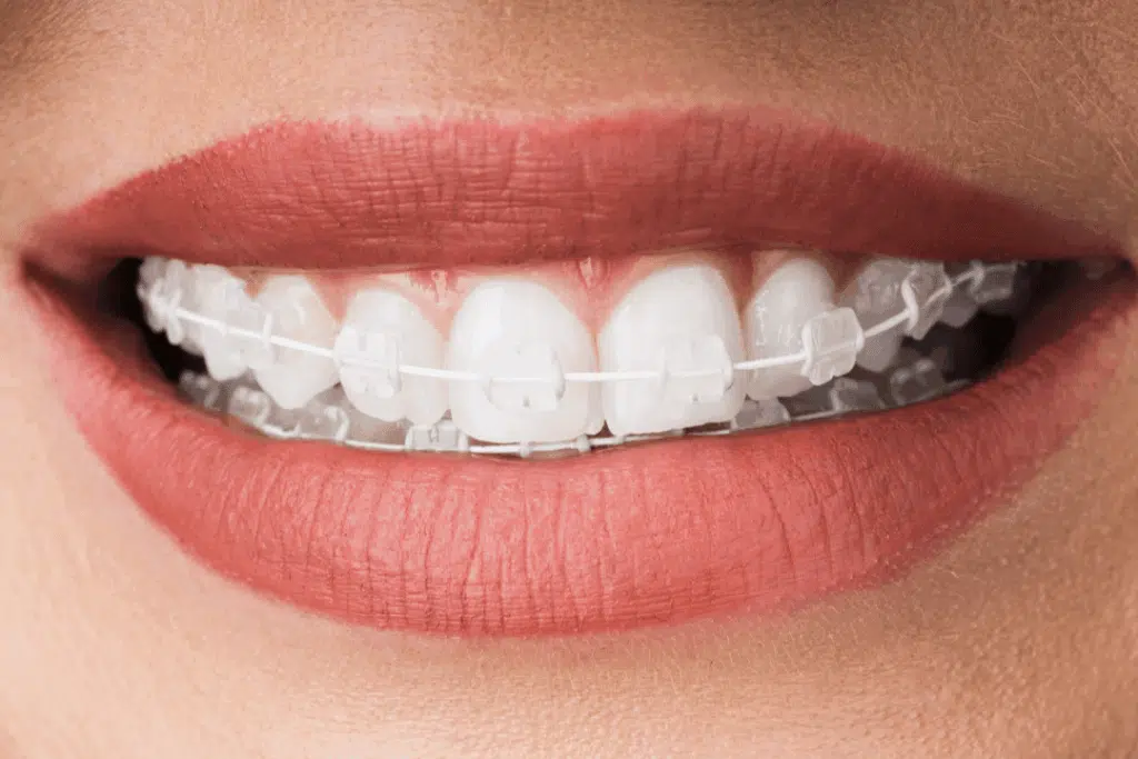 Ceramic braces for adults improving jaw alignment and breathing