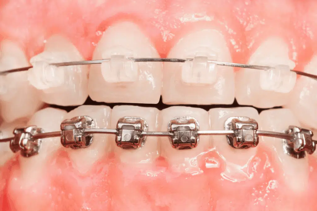 metal braces and ceramic braces improving jaw stability