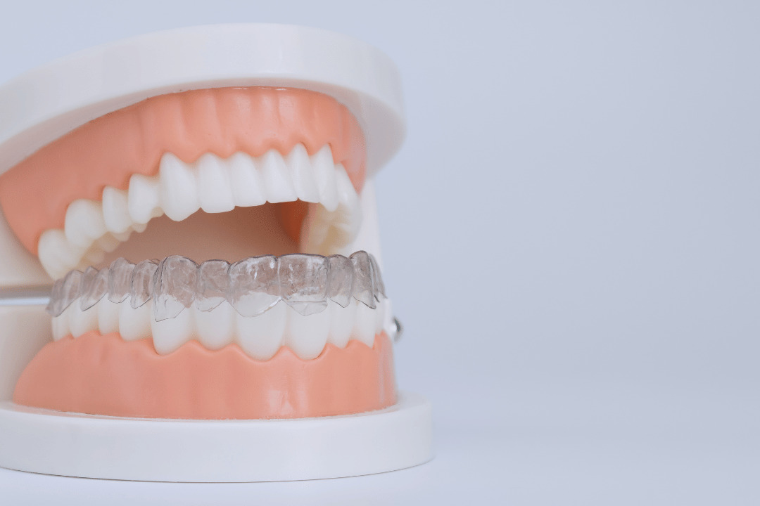 Retainers Preventing Tooth Movement