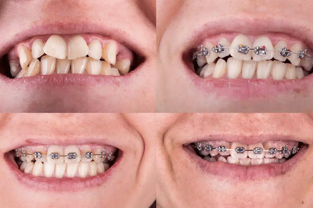 Teeth Shift After Braces