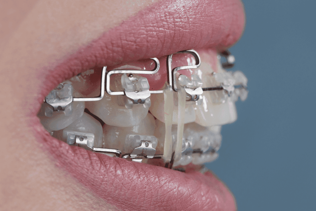 bite analysis for metal braces