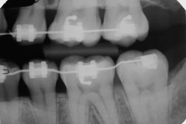 orthodontic tooth movement pressure and tension