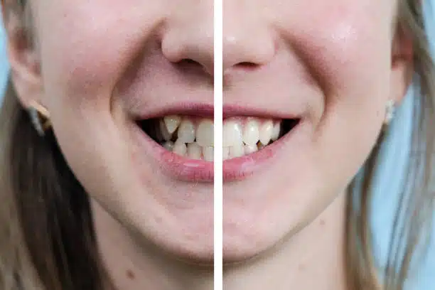 Before and after Invisalign crowding result