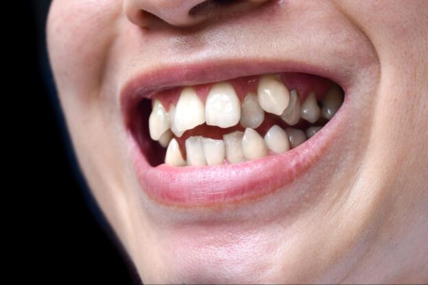 Close-up of stacked or overlapping teeth of a man. Also called crowded teeth.
