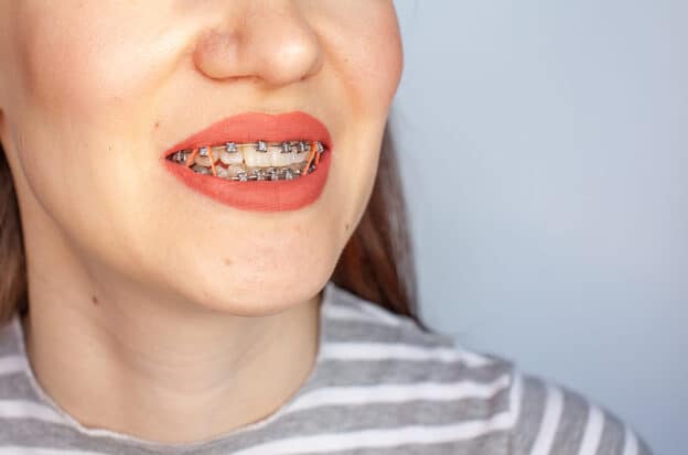 Patient wearing braces with elastic bands in Manhattan orthodontic office