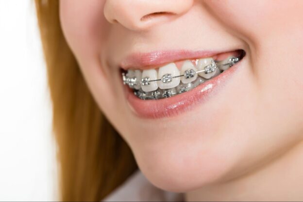 braces in Brooklyn NY for adult overbite correction