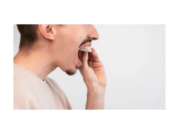 How to insert Invisalign
