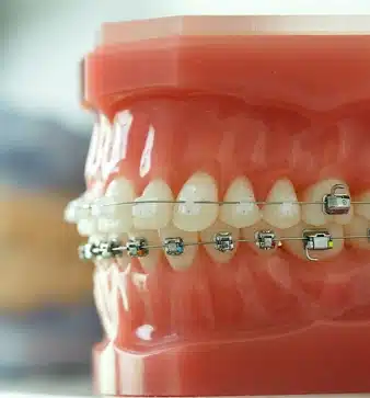 Best Types of Braces